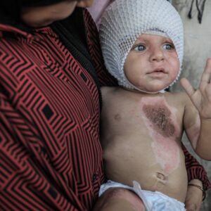 gazzede vucudu yanan 1 yasindaki muhammed yardim bekliyor n4AvkrvY