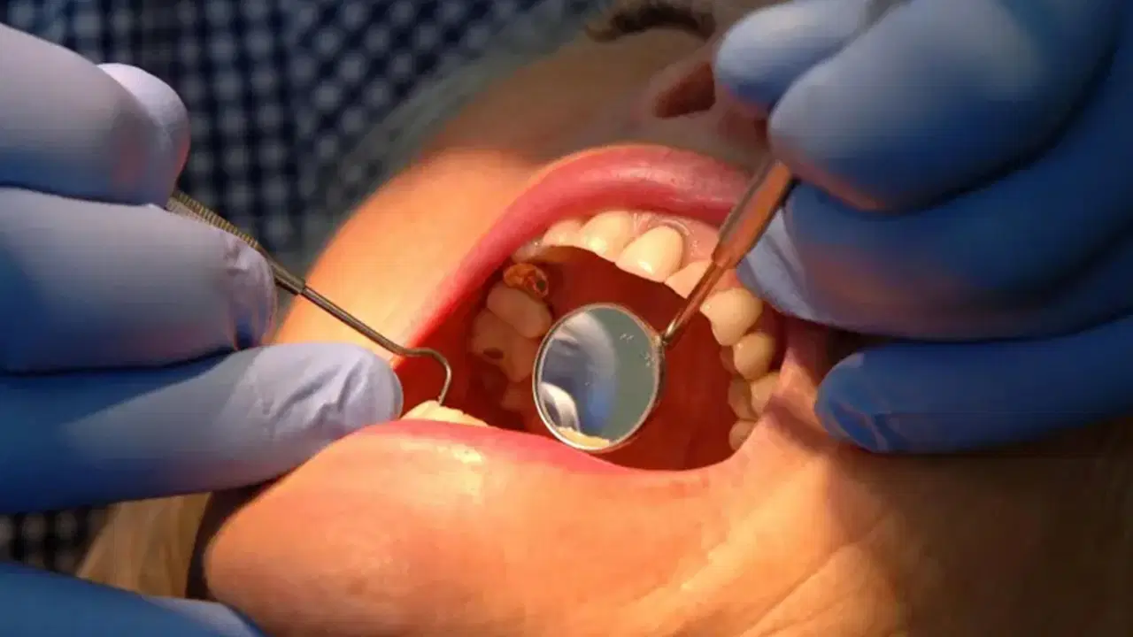 dis minesini onaran yeni jel curuklerin sonu mu geliyor ZfPYhFj3.jpg